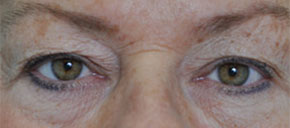 blepharoplasty eyelid lift procedure somenek and pittman washington dc before image