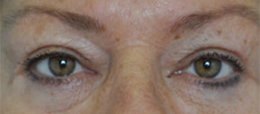 blepharoplasty eyelid lift procedure somenek and pittman washington dc after image