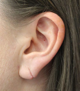 earlobe repair before image somenek and pittman washington dc