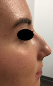 Nose before a non-surgical rhinoplasty