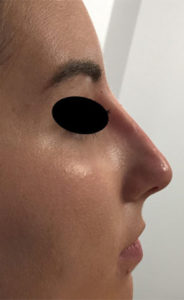 Result of a non-surgical rhinoplasty