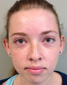 Patient's ears after  otoplasty front view