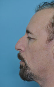 Male Patient's nose before the rhinoplasty, left side.