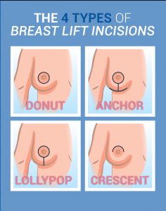 DC Breast Lift Incision Procedure