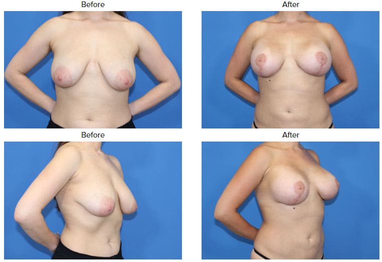 Breast Lift with Implants in Washington DC