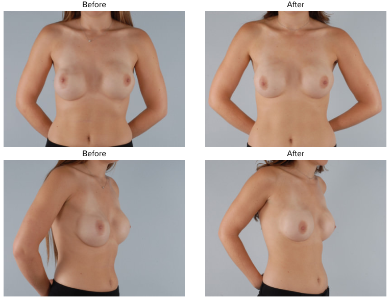 Revision Breast Reconstruction in Washington DC