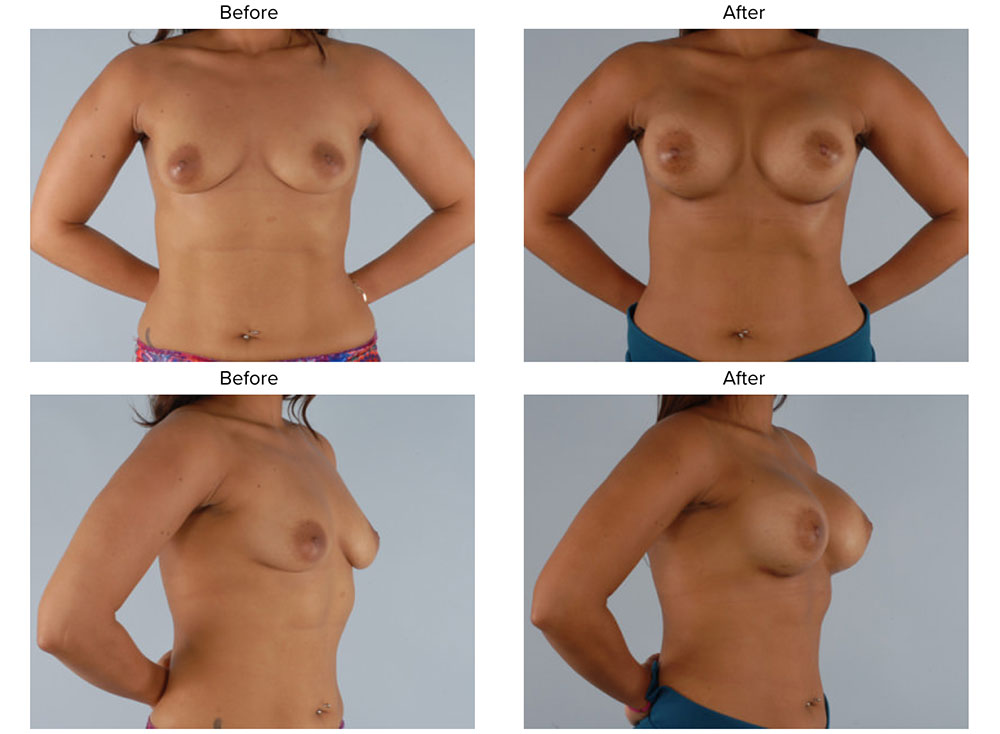 Revision Breast Augmentation in Washington DC