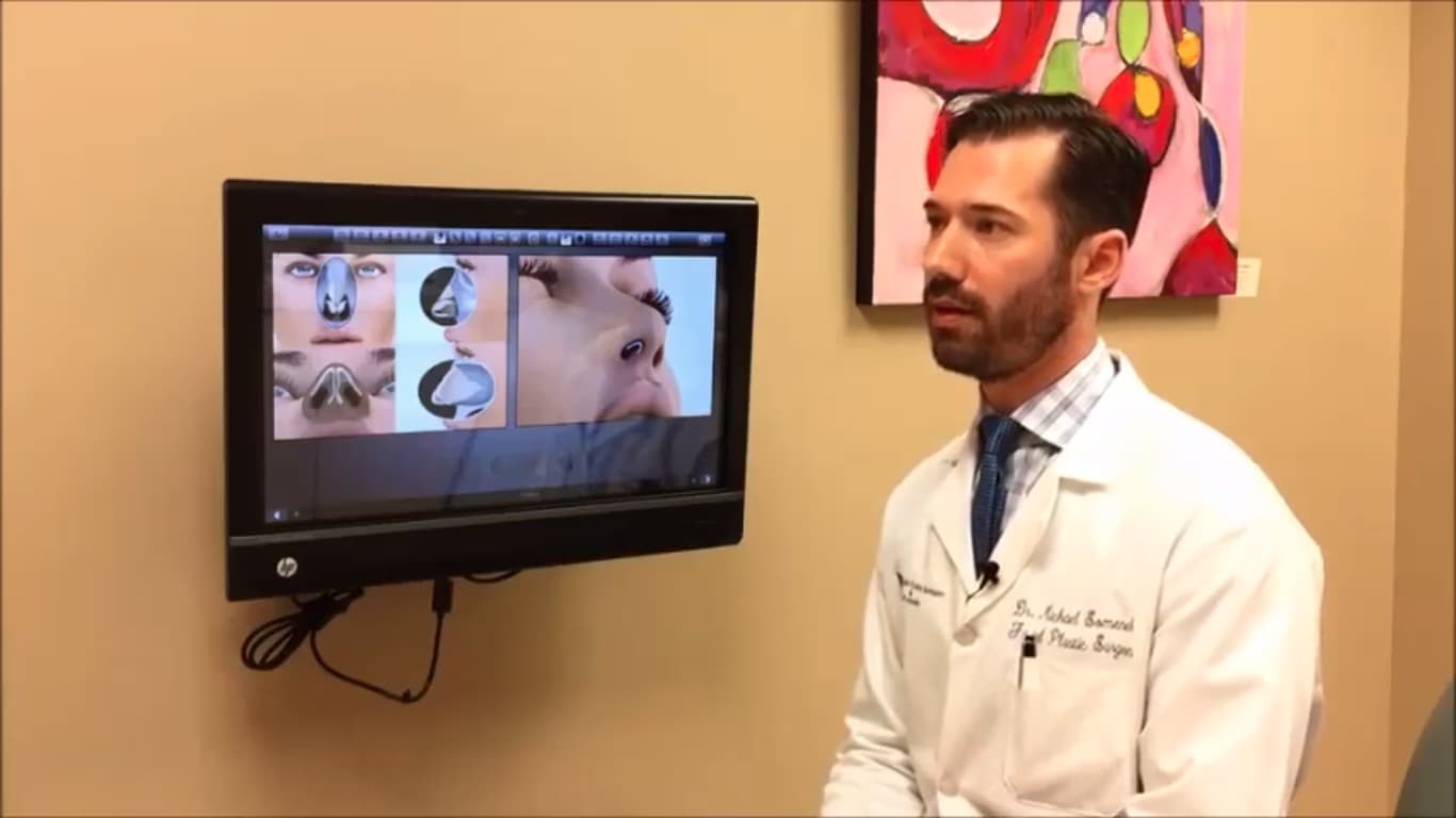 rhinoplasty