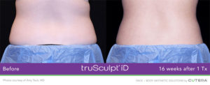 truSculpt iD Procedure Results