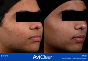 before and after image aviclear acne laser treatment somenek and pittman aashington, dc patient #2