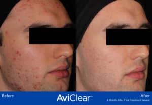 before and after image aviclear acne laser treatment somenek and pittman aashington, dc patient #4
