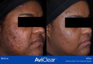 before and after image aviclear acne laser treatment somenek and pittman aashington, dc patient #3