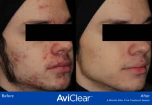 before and after image aviclear acne laser treatment somenek and pittman aashington, dc patient #5