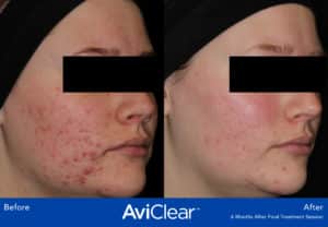 before and after image aviclear acne laser treatment somenek and pittman aashington, dc patient #1