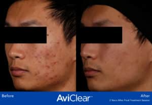 before and after image aviclear acne laser treatment somenek and pittman aashington, dc patient #7