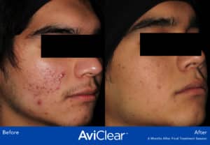 before and after image aviclear acne laser treatment somenek and pittman aashington, dc patient #6