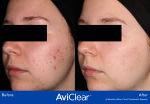before and after image aviclear acne laser treatment somenek and pittman aashington, dc patient #8
