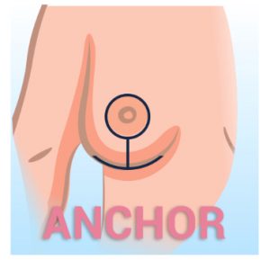Anchor Breast Reduction DC