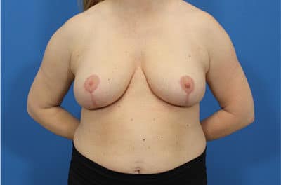 Breast Reduction Results 1