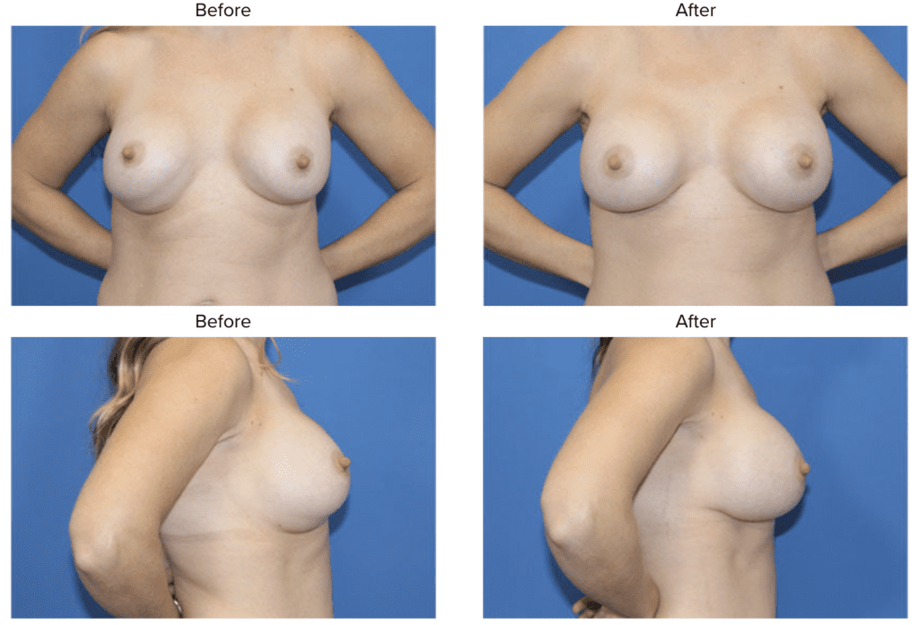 DC Breast Implant Removal Healing 1
