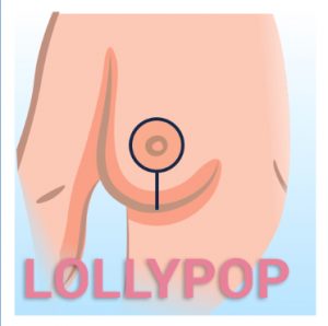 DC Lollypop Breast Reduction