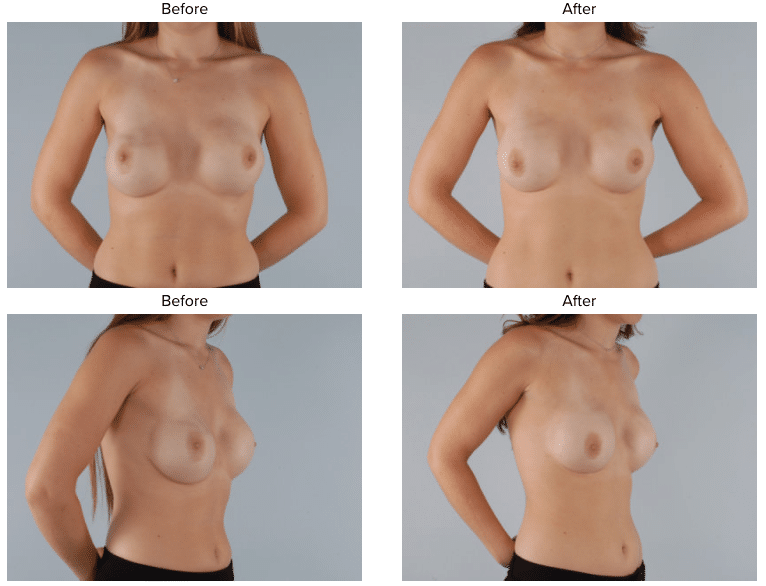 DC Revision Breast Reconstruction 1