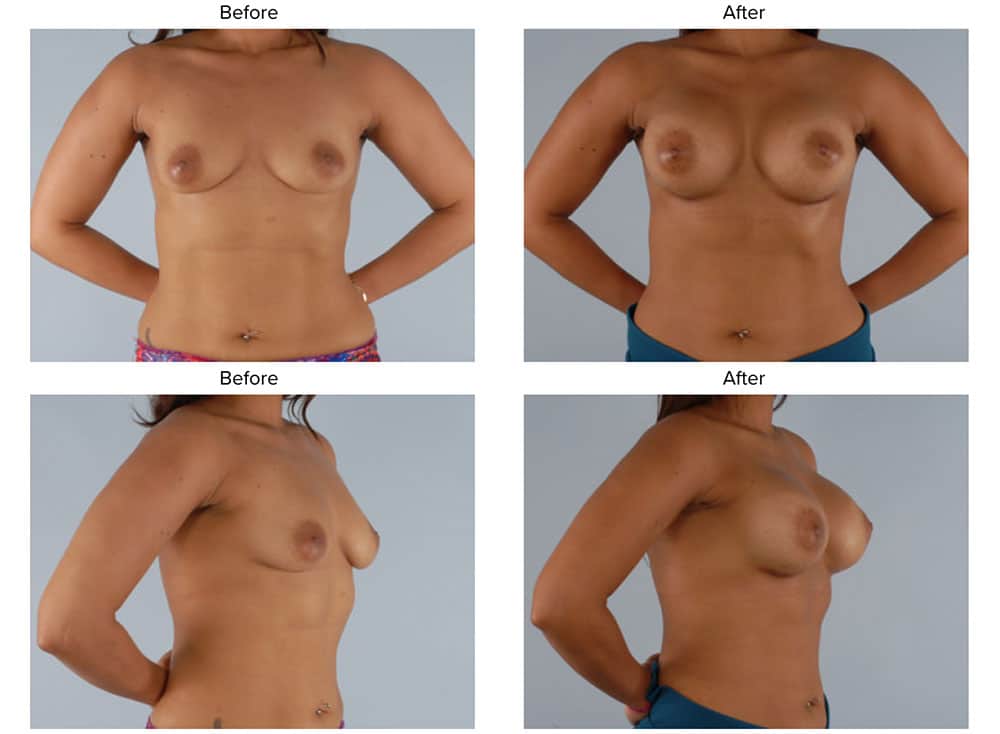 breast augmentation bxa