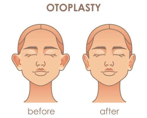 otoplasty ear surgery vector illustration of female face before and after plastic surgery.jpg s1024x1024wisk20cqZ1 FSDRxVZ rJ H8gVmJkM70u7ExpPKcltnA3CGviE