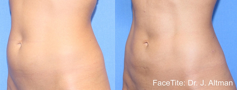 BodyTite Stomach Procedure Results