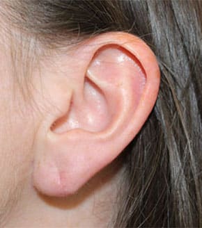 earlobe repair bxa2
