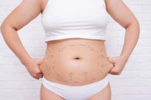 Image of woman’s abdomen with marks indicating lines for tummy tuck surgery