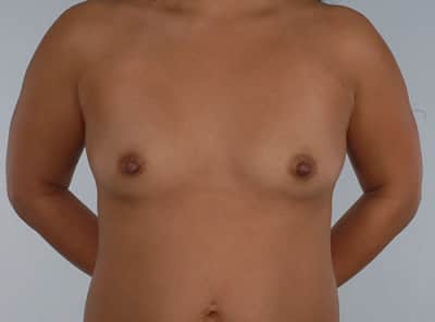 Real patient Breast Augmentation by Dr.Pittman, Washington D.C.