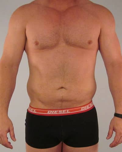 Real patient Liposuction by Dr.Pittman, Washington D.C.