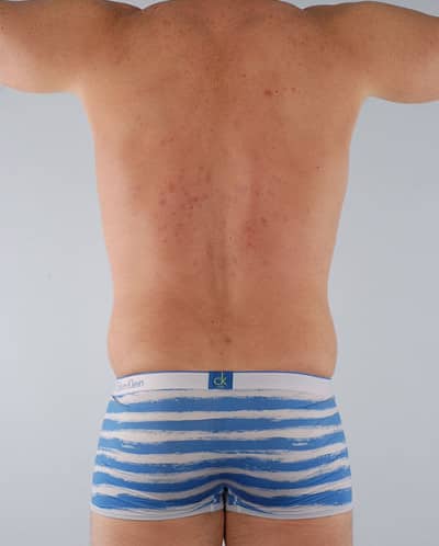 Real patient Liposuction by Dr.Pittman, Washington D.C.