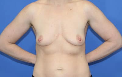 Real patient Breast Augmentation by Dr.Pittman, Washington D.C.