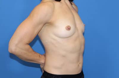 Real patient Breast Augmentation by Dr.Pittman, Washington D.C.