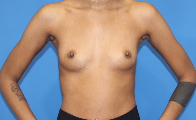 Real patient Breast Augmentation by Dr.Pittman, Washington D.C.
