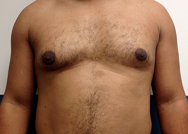 Real patient Gynecomastia by Dr.Pittman, Washington D.C.