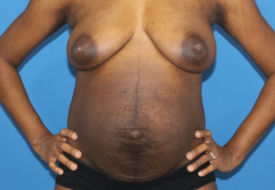 Real patient Abdominoplasty by Dr.Pittman, Washington D.C.
