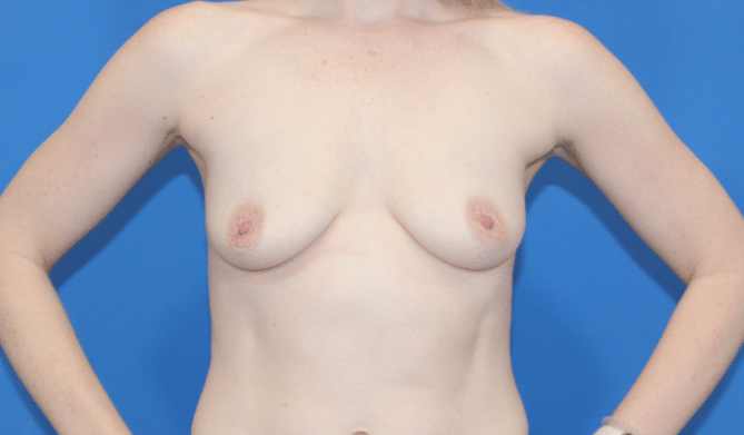 Real patient Breast Augmentation by Dr.Pittman, Washington D.C.