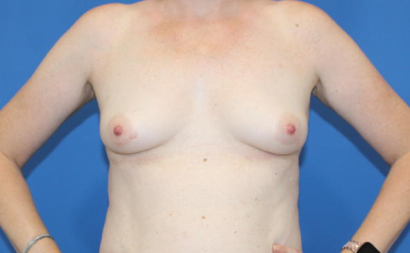Real patient Breast Augmentation by Dr.Pittman, Washington D.C.