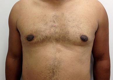 Real patient Gynecomastia by Dr.Pittman, Washington D.C.