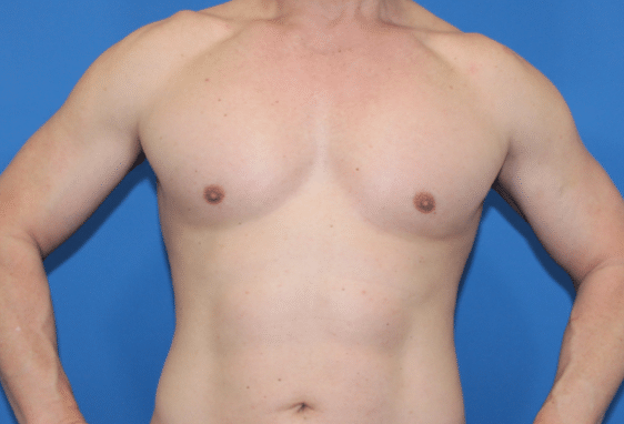 Real patient Pectoral Augmentation by Dr.Pittman, Washington D.C.