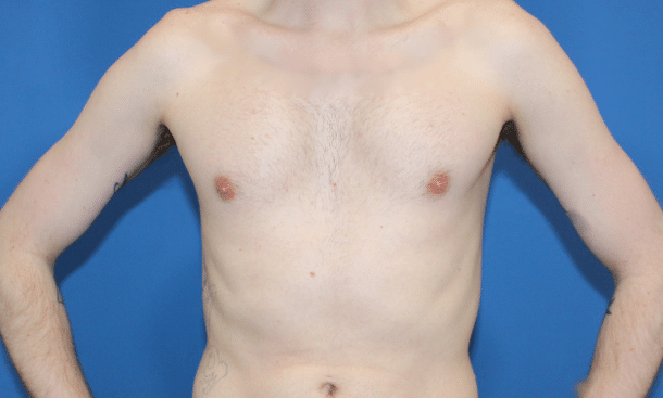 Real patient Pectoral Augmentation by Dr.Pittman, Washington D.C.
