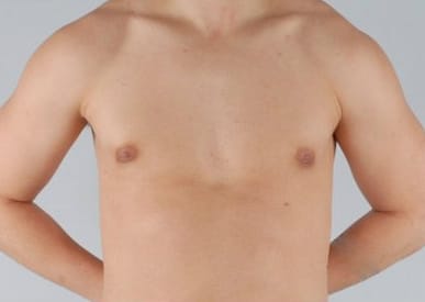 Real patient Gynecomastia by Dr.Pittman, Washington D.C.