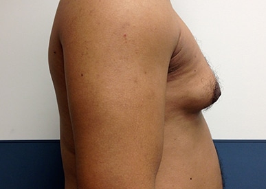 Real patient Gynecomastia by Dr.Pittman, Washington D.C.