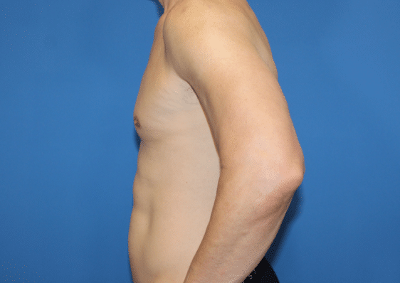 Real patient Pectoral Augmentation by Dr.Pittman, Washington D.C.