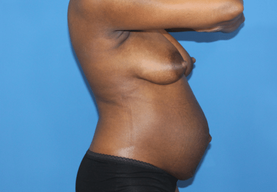 Real patient Abdominoplasty by Dr.Pittman, Washington D.C.