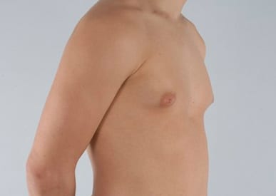 Real patient Gynecomastia by Dr.Pittman, Washington D.C.