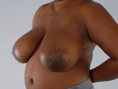 Real patient Breast Reduction by Dr.Pittman, Washington D.C.